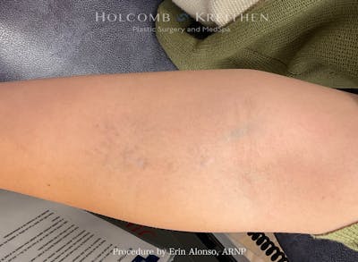 Tattoo Removal Before & After Gallery - Patient 336060 - Image 2