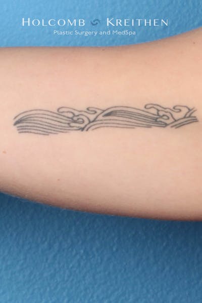 Tattoo Removal Before & After Gallery - Patient 100885 - Image 1