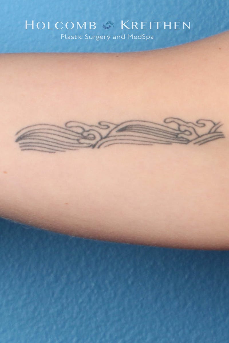 Tattoo Removal Before & After Gallery - Patient 100885 - Image 1