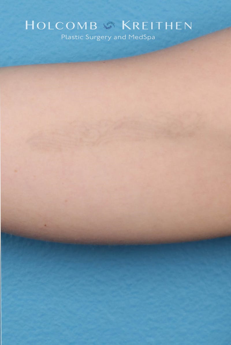 Tattoo Removal Before & After Gallery - Patient 100885 - Image 2