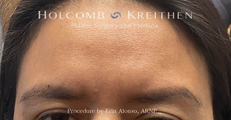 Tattoo Removal Before & After Gallery - Patient 722706 - Image 1