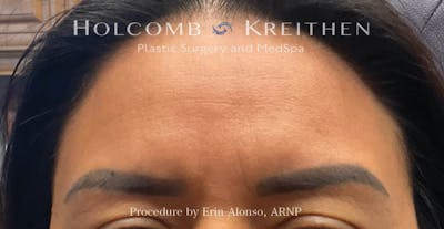 Tattoo Removal Before & After Gallery - Patient 722706 - Image 2