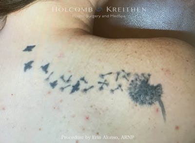 Tattoo Removal Before & After Gallery - Patient 348441 - Image 1