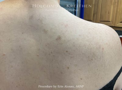 Tattoo Removal Before & After Gallery - Patient 348441 - Image 2