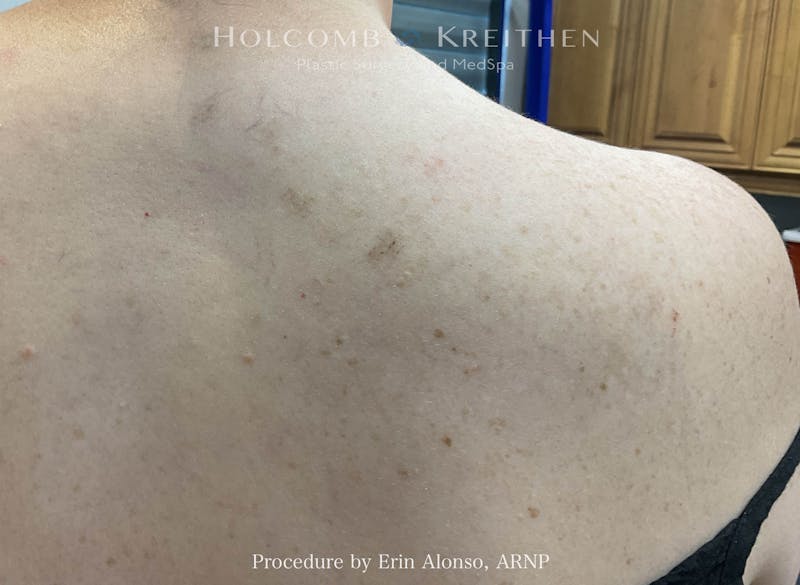 Tattoo Removal Before & After Gallery - Patient 348441 - Image 2