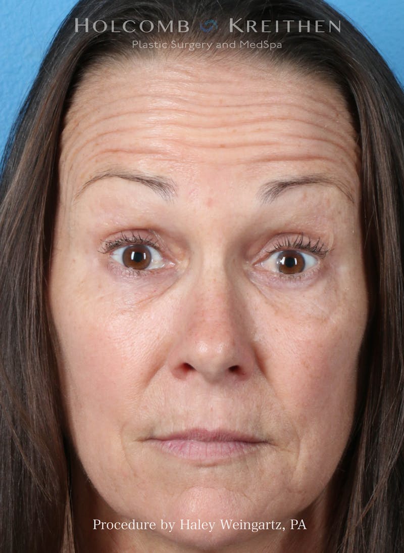 BOTOX Before & After Gallery - Patient 613685 - Image 1