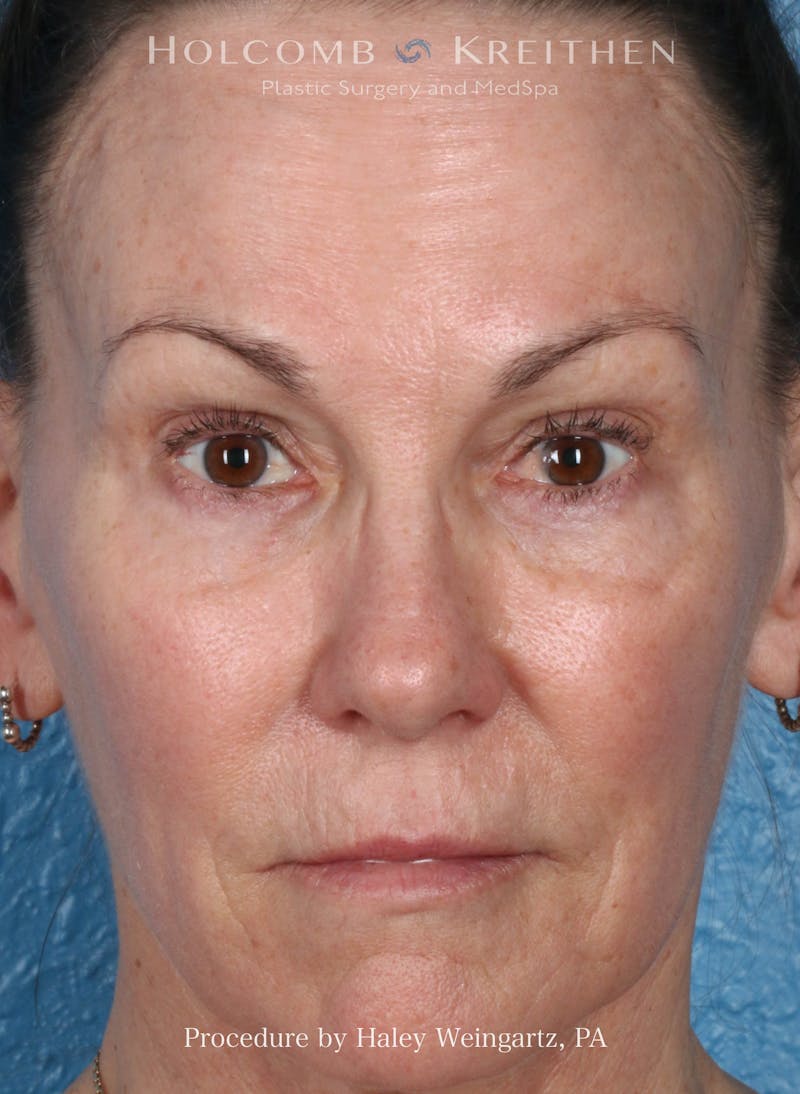 BOTOX Before & After Gallery - Patient 613685 - Image 2