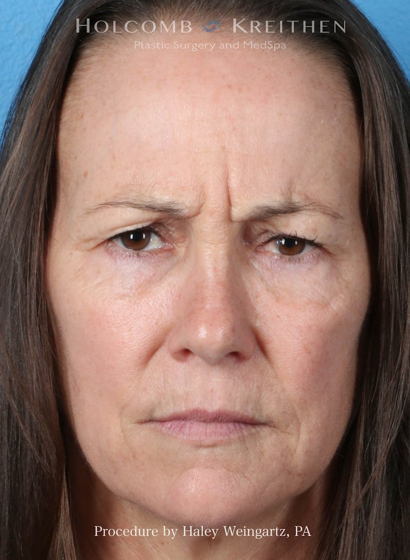 BOTOX Before & After Gallery - Patient 613685 - Image 3