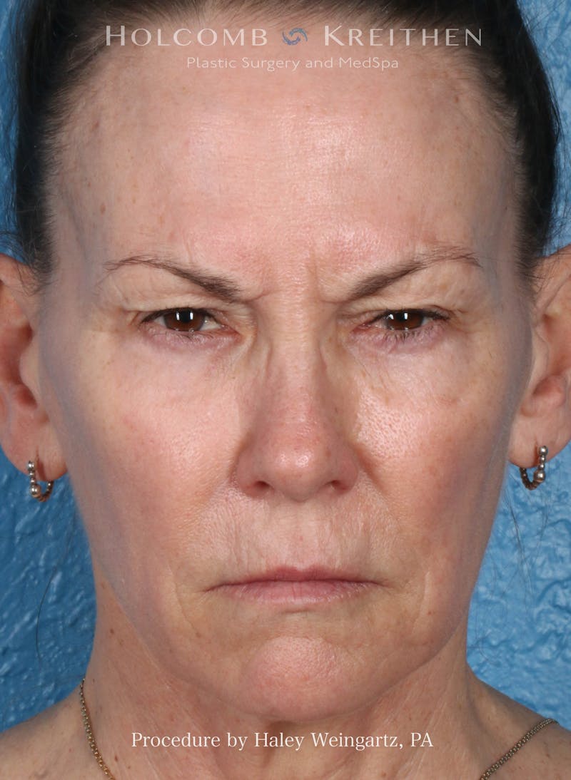 BOTOX Before & After Gallery - Patient 613685 - Image 4