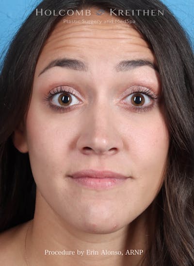 BOTOX Before & After Gallery - Patient 273597 - Image 1
