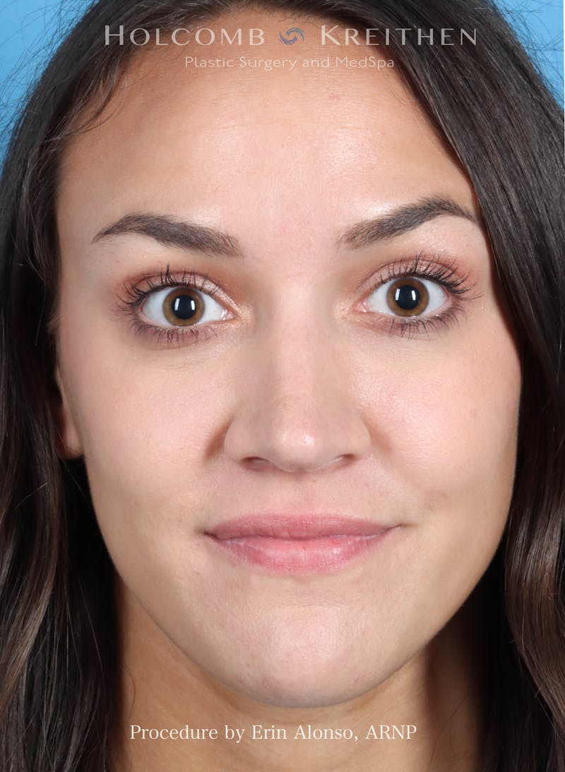BOTOX Before & After Gallery - Patient 273597 - Image 2