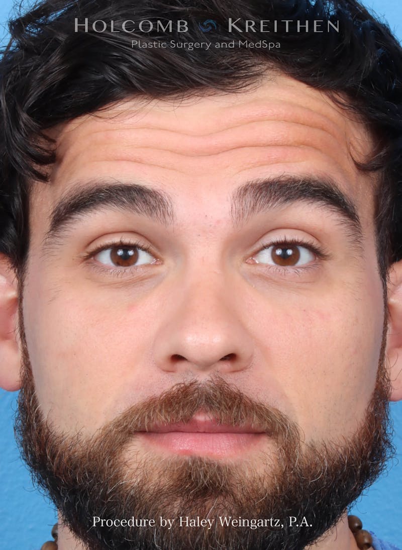 BOTOX Before & After Gallery - Patient 244101 - Image 1