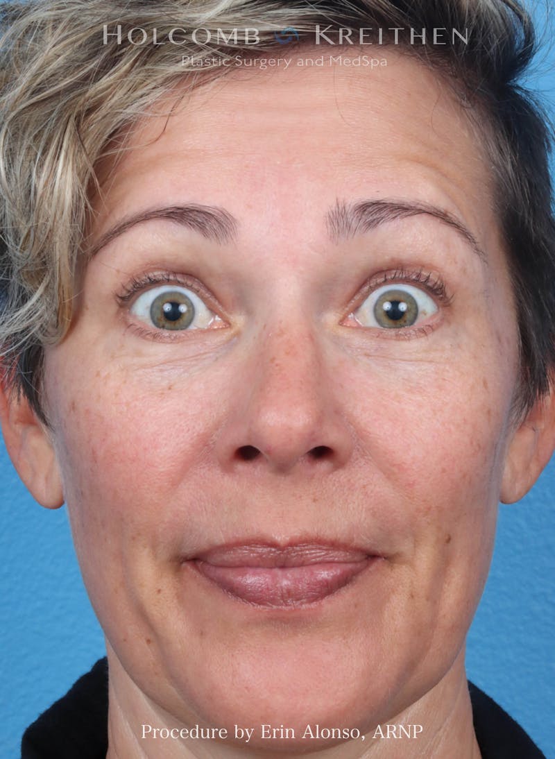 BOTOX Before & After Gallery - Patient 266413 - Image 1
