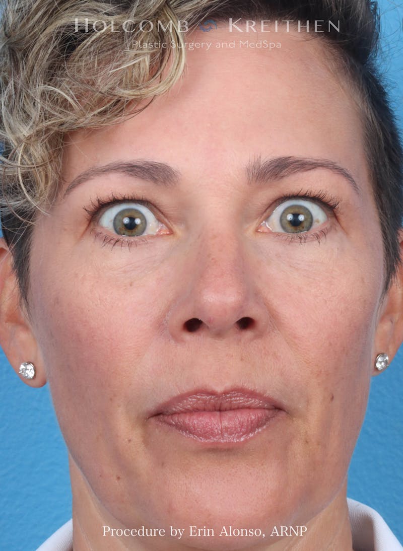 BOTOX Before & After Gallery - Patient 266413 - Image 2