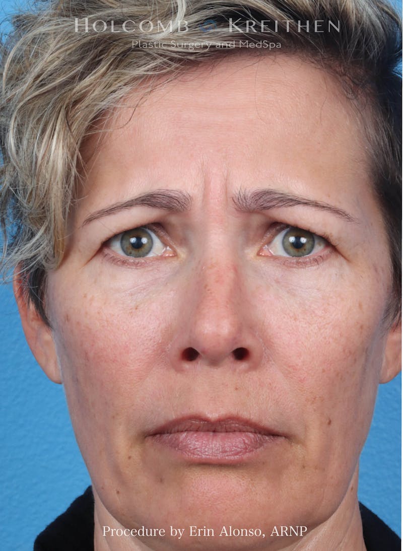 BOTOX Before & After Gallery - Patient 266413 - Image 3