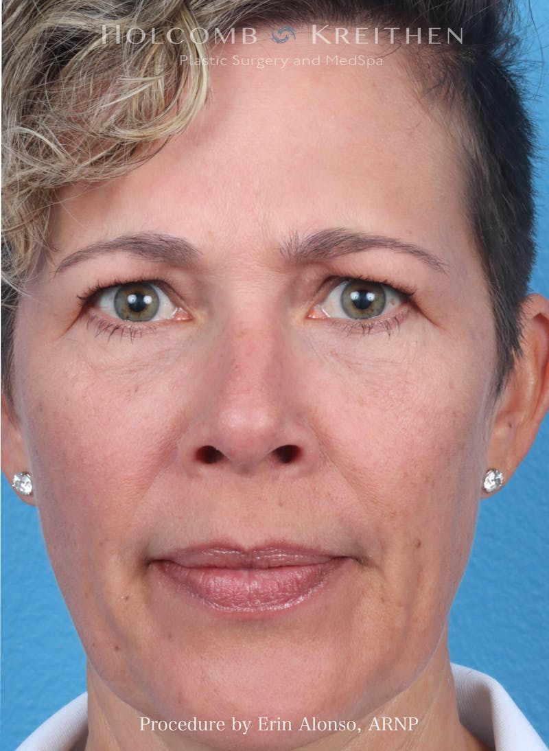 BOTOX Before & After Gallery - Patient 266413 - Image 4