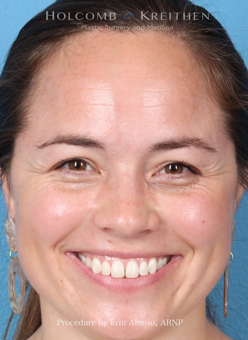 BOTOX Before & After Gallery - Patient 241942 - Image 1