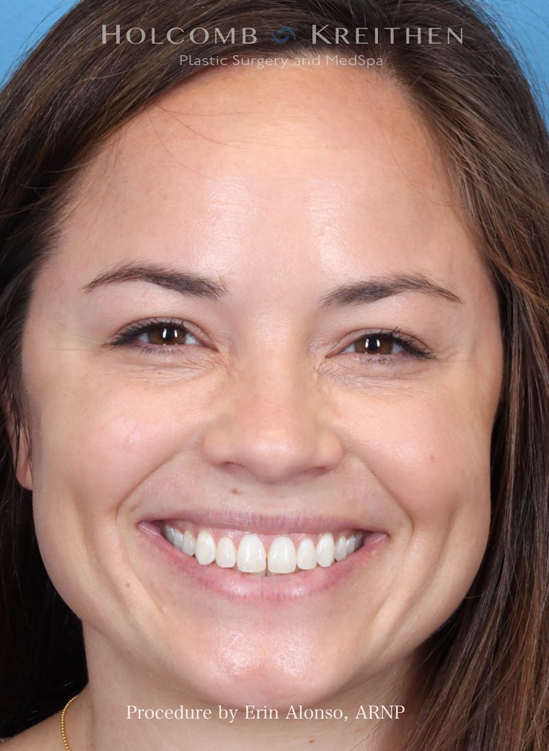 BOTOX Before & After Gallery - Patient 241942 - Image 2