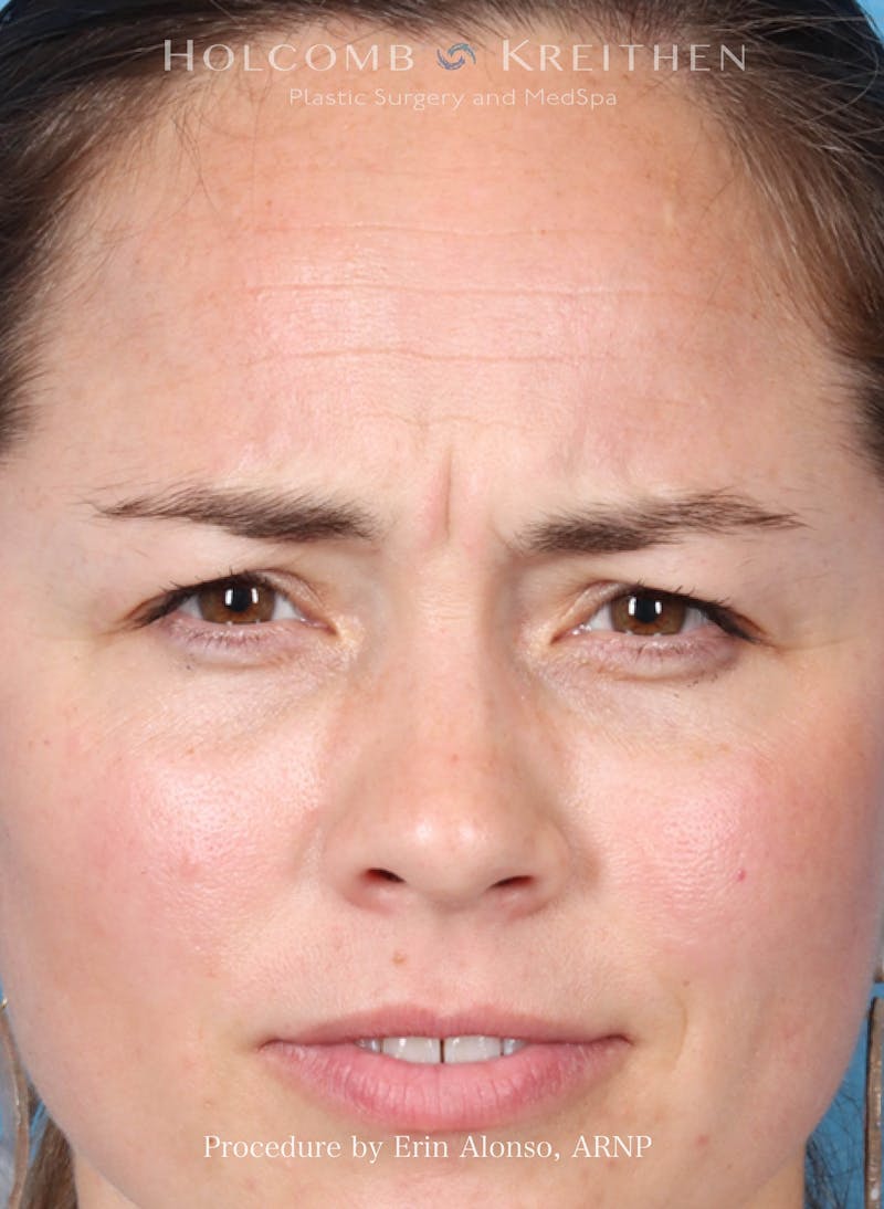 BOTOX Before & After Gallery - Patient 241942 - Image 3