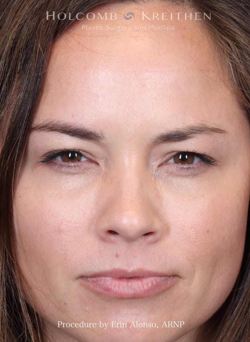 BOTOX Before & After Gallery - Patient 241942 - Image 4