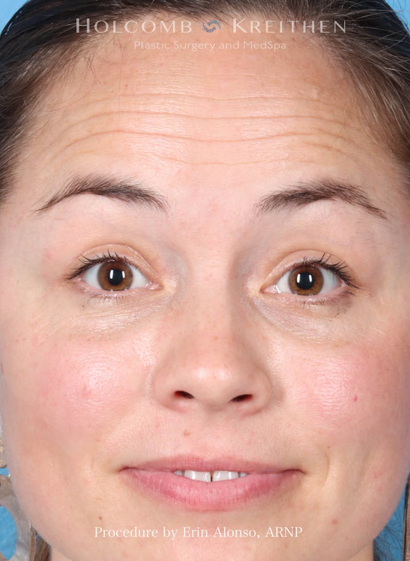 BOTOX Before & After Gallery - Patient 241942 - Image 5