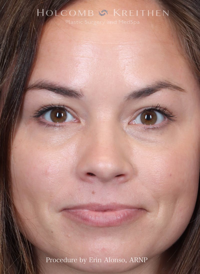 BOTOX Before & After Gallery - Patient 241942 - Image 6
