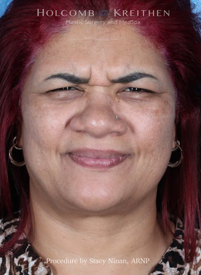 BOTOX Before & After Gallery - Patient 394394 - Image 1
