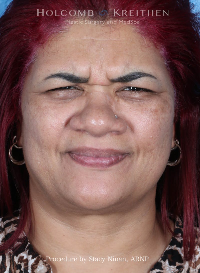 BOTOX Before & After Gallery - Patient 394394 - Image 1
