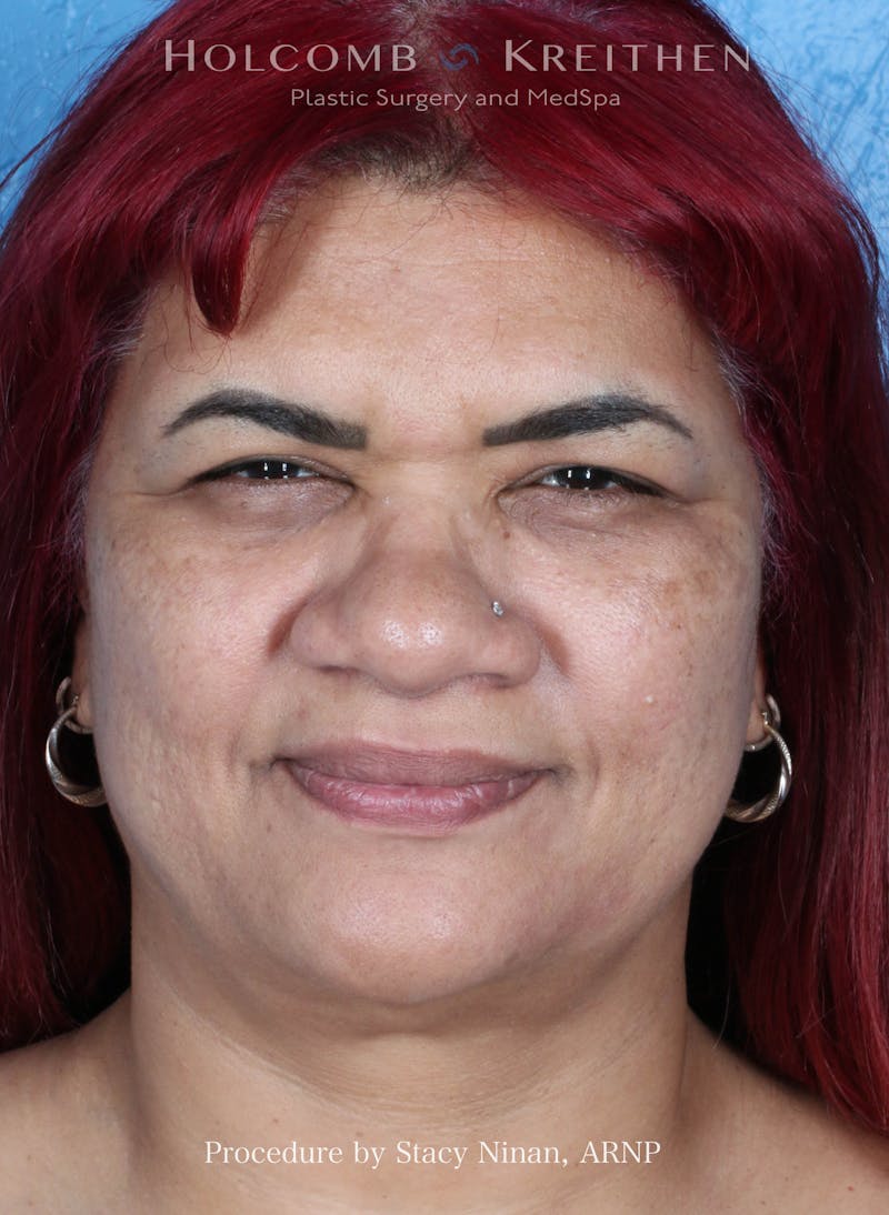 BOTOX Before & After Gallery - Patient 394394 - Image 2