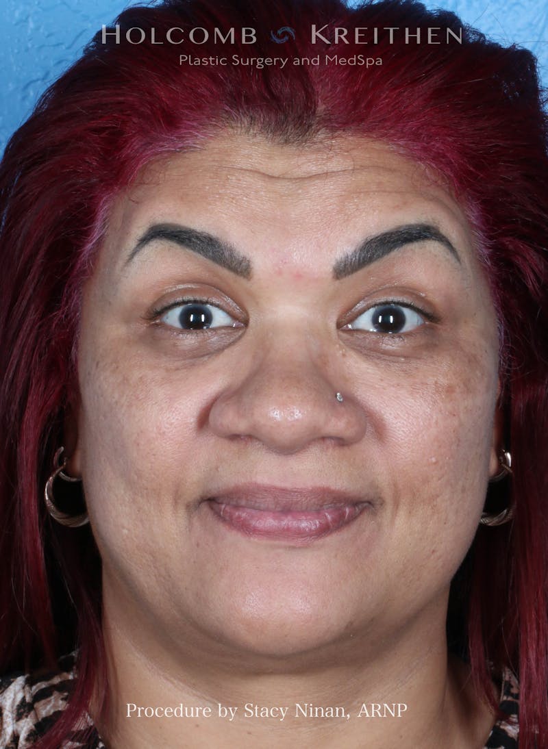 BOTOX Before & After Gallery - Patient 394394 - Image 3