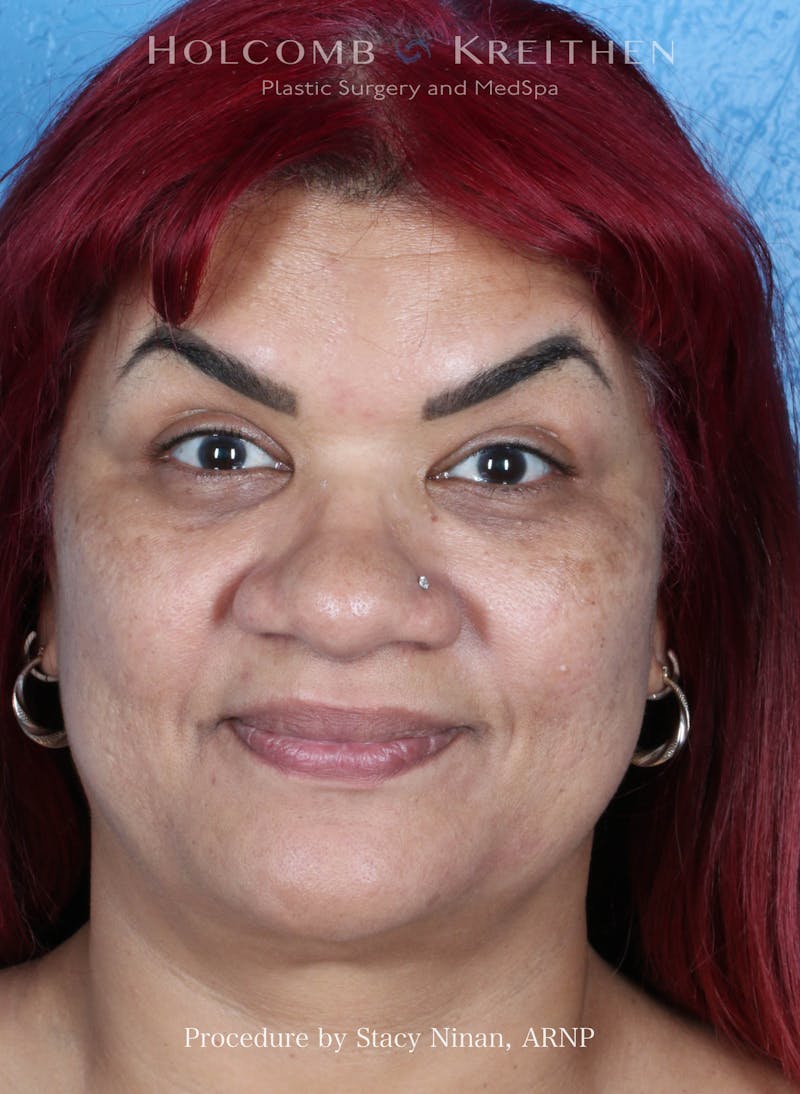 BOTOX Before & After Gallery - Patient 394394 - Image 4