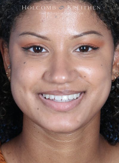 BOTOX Before & After Gallery - Patient 458483 - Image 1
