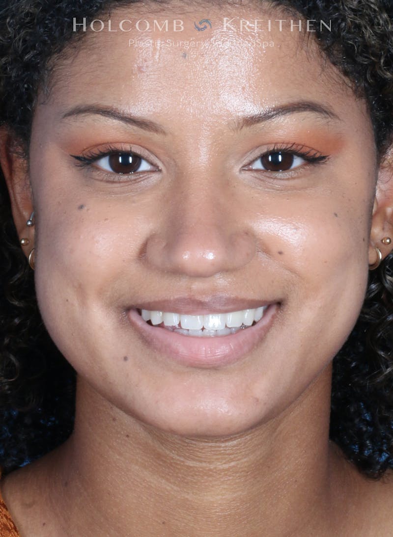 BOTOX Before & After Gallery - Patient 458483 - Image 1