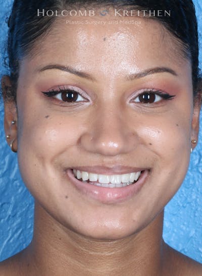 BOTOX Before & After Gallery - Patient 458483 - Image 2