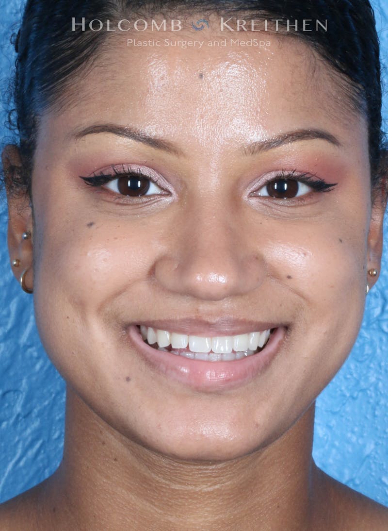 BOTOX Before & After Gallery - Patient 458483 - Image 2