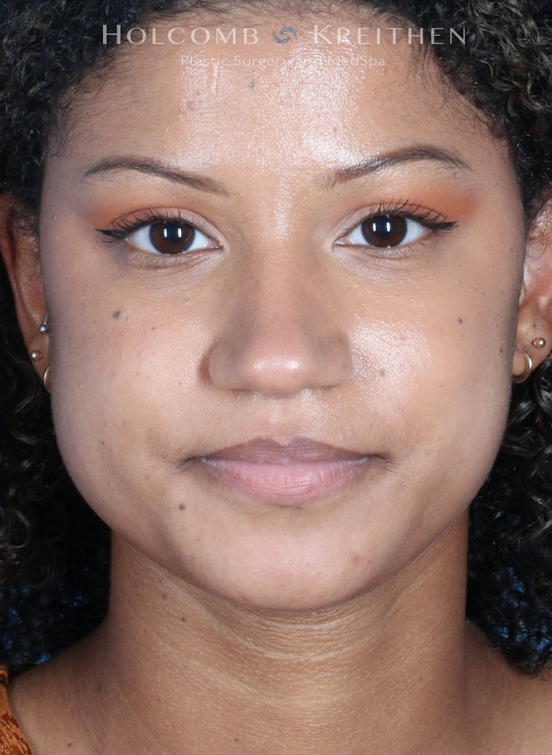 BOTOX Before & After Gallery - Patient 458483 - Image 3