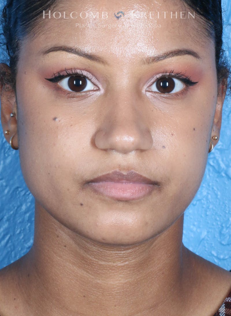 BOTOX Before & After Gallery - Patient 458483 - Image 4