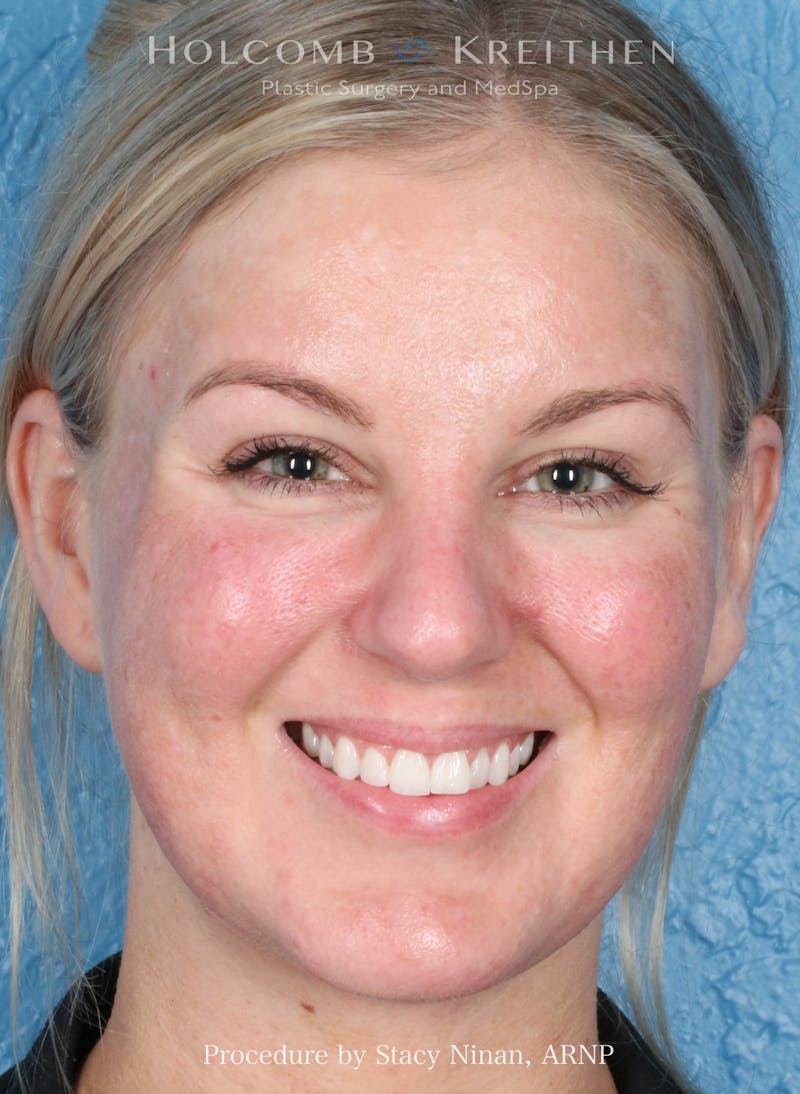 Complexion Code Plus Before & After Gallery - Patient 160292 - Image 1
