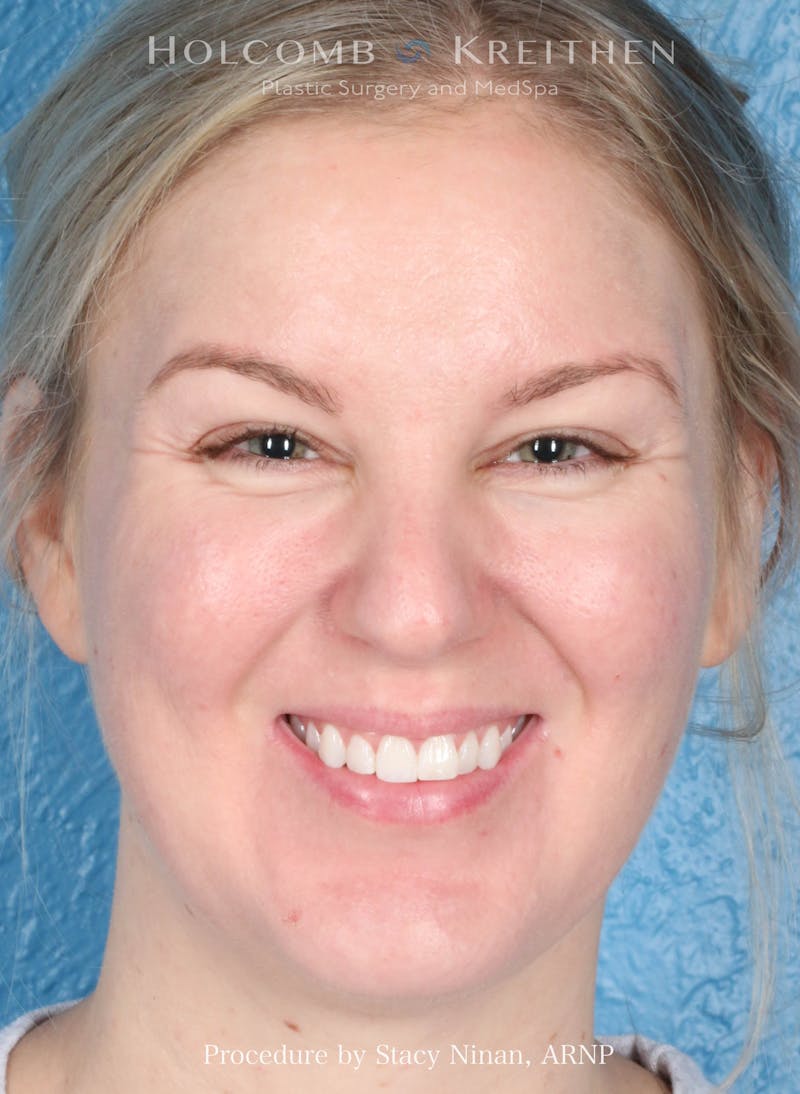 Complexion Code Plus Before & After Gallery - Patient 160292 - Image 2