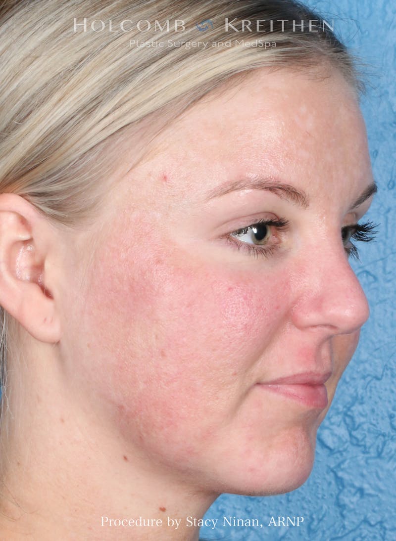 Complexion Code Plus Before & After Gallery - Patient 160292 - Image 3
