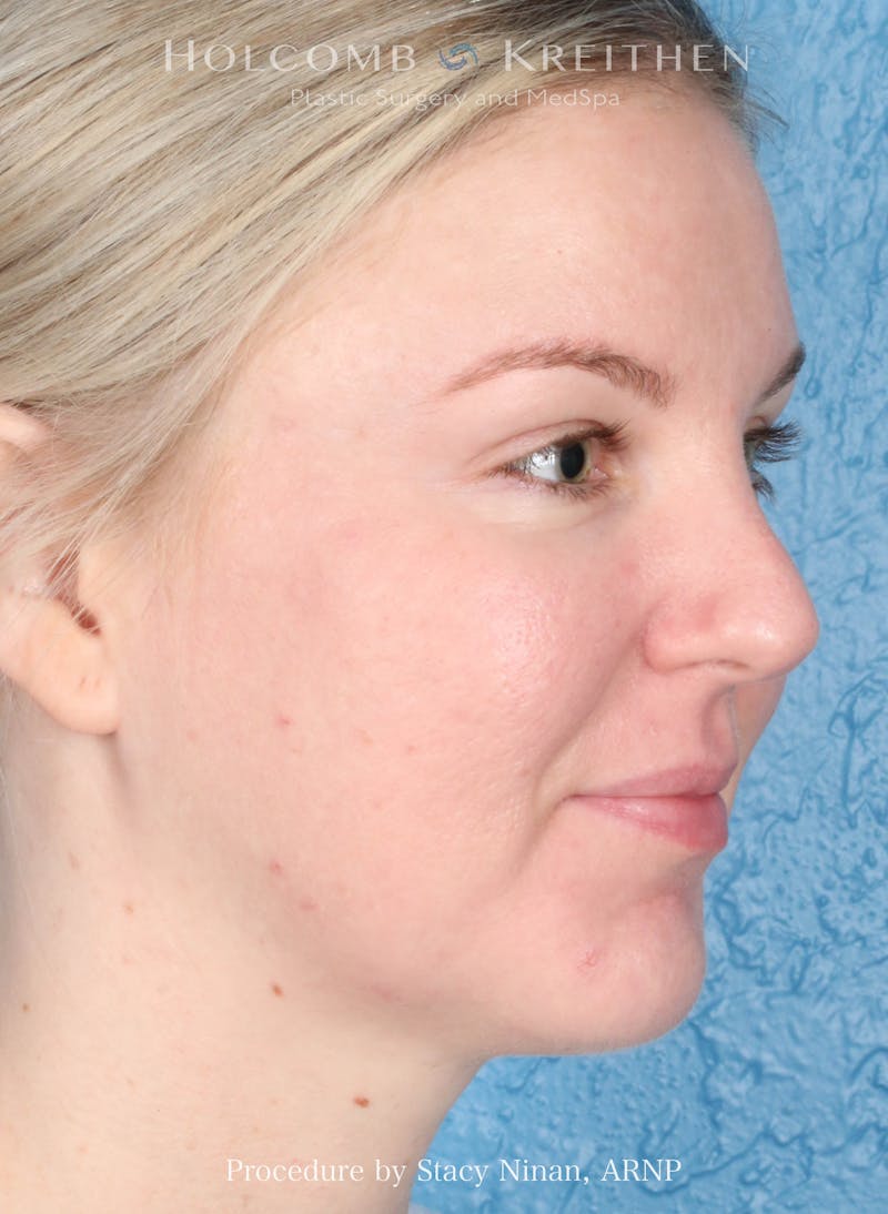 Complexion Code Plus Before & After Gallery - Patient 160292 - Image 4