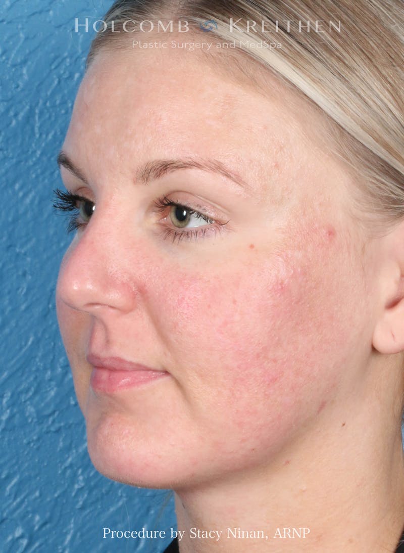 Complexion Code Plus Before & After Gallery - Patient 160292 - Image 5