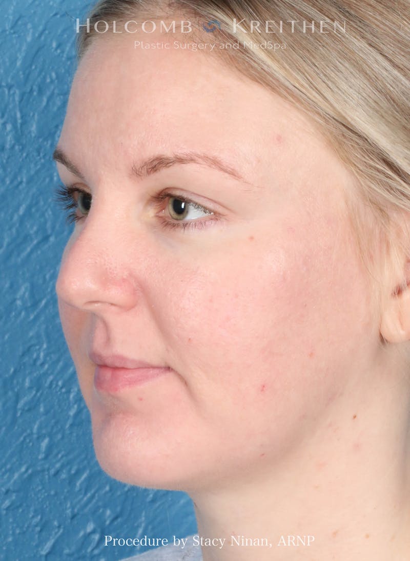 Complexion Code Plus Before & After Gallery - Patient 160292 - Image 6