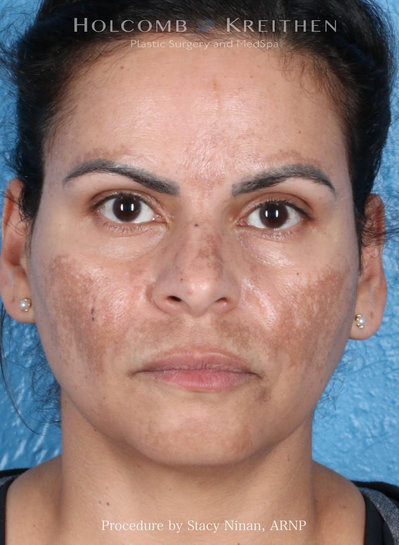 Complexion Code Plus Before & After Gallery - Patient 125026 - Image 1