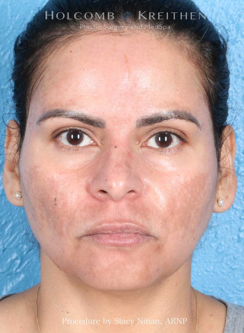Complexion Code Plus Before & After Gallery - Patient 125026 - Image 2
