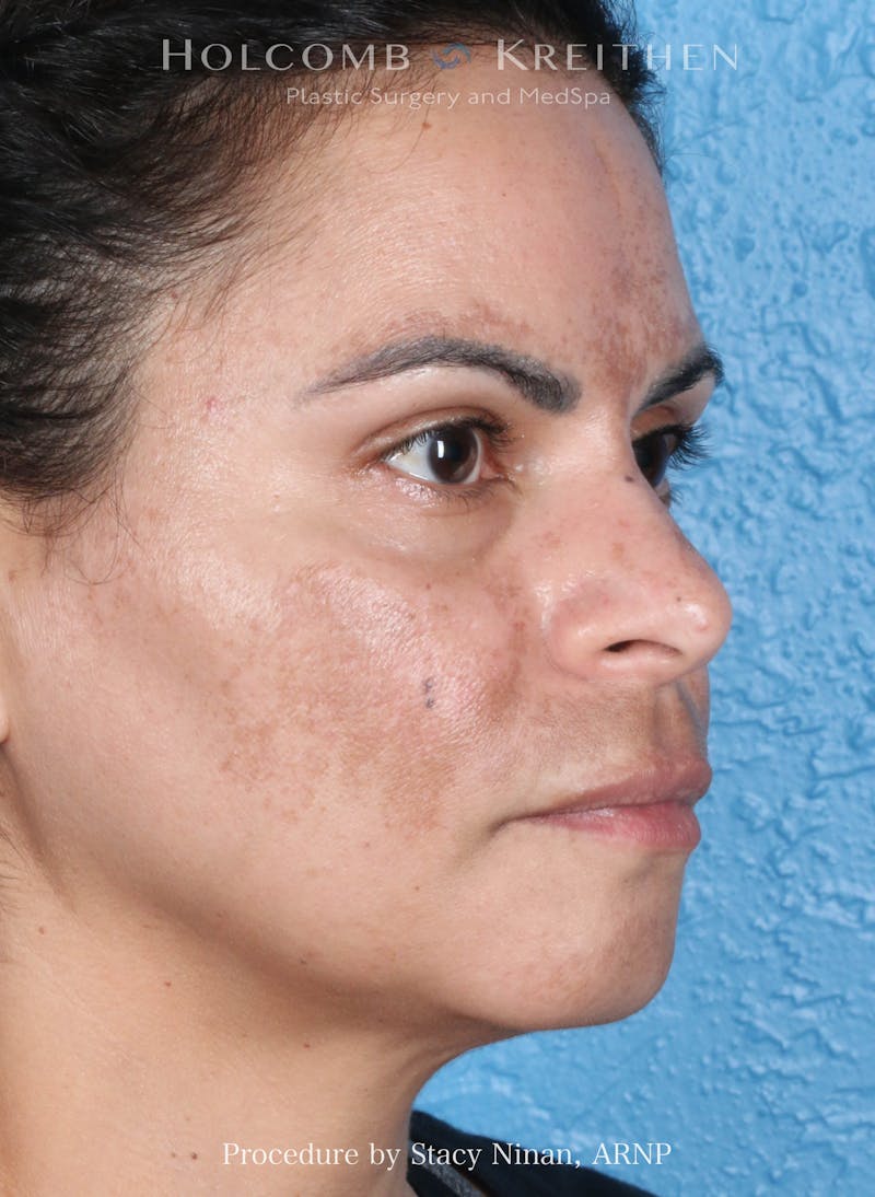 Complexion Code Plus Before & After Gallery - Patient 125026 - Image 3