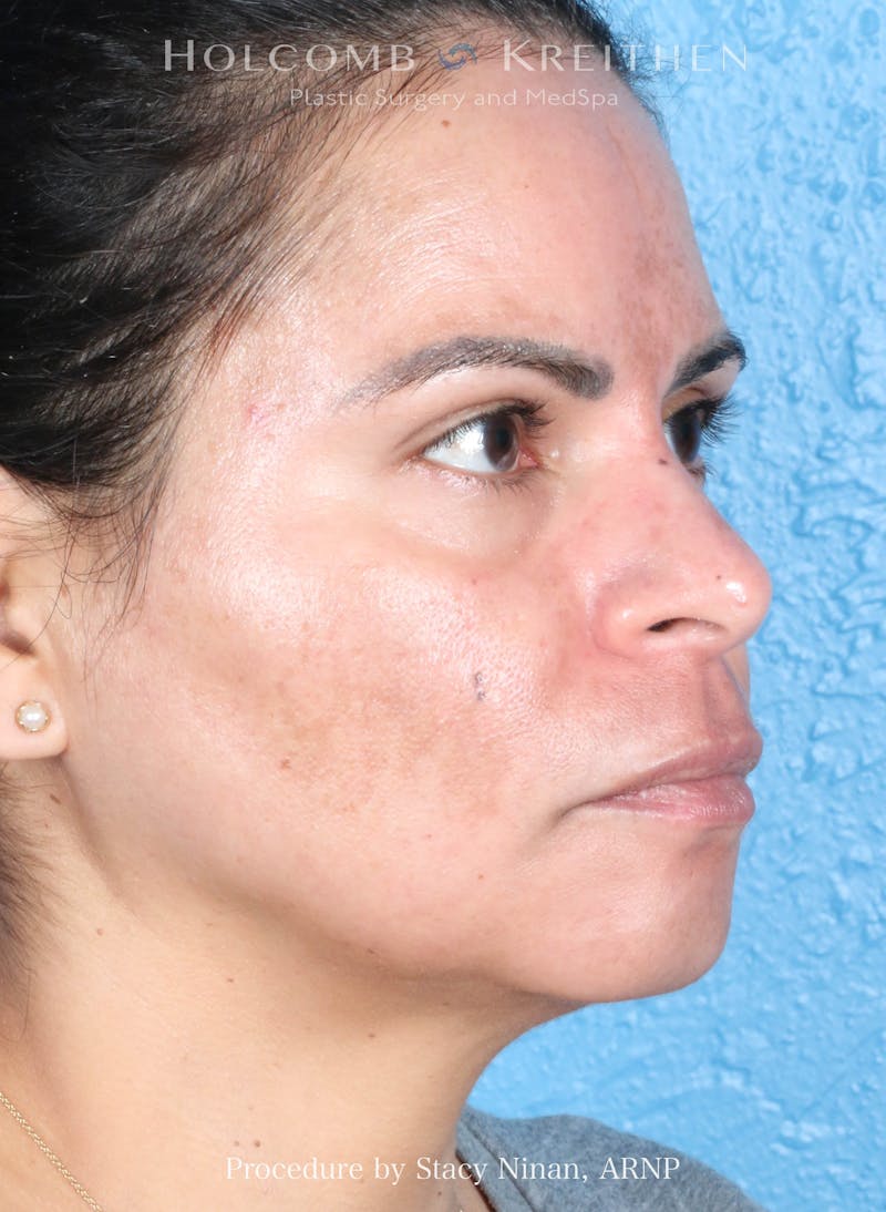 Complexion Code Plus Before & After Gallery - Patient 125026 - Image 4