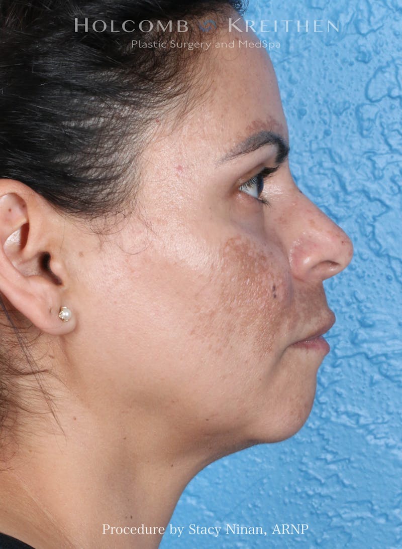 Complexion Code Plus Before & After Gallery - Patient 125026 - Image 5