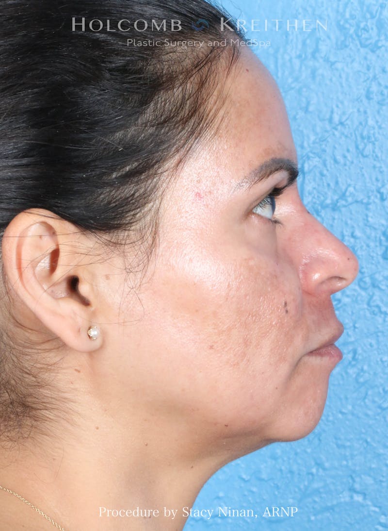 Complexion Code Plus Before & After Gallery - Patient 125026 - Image 6