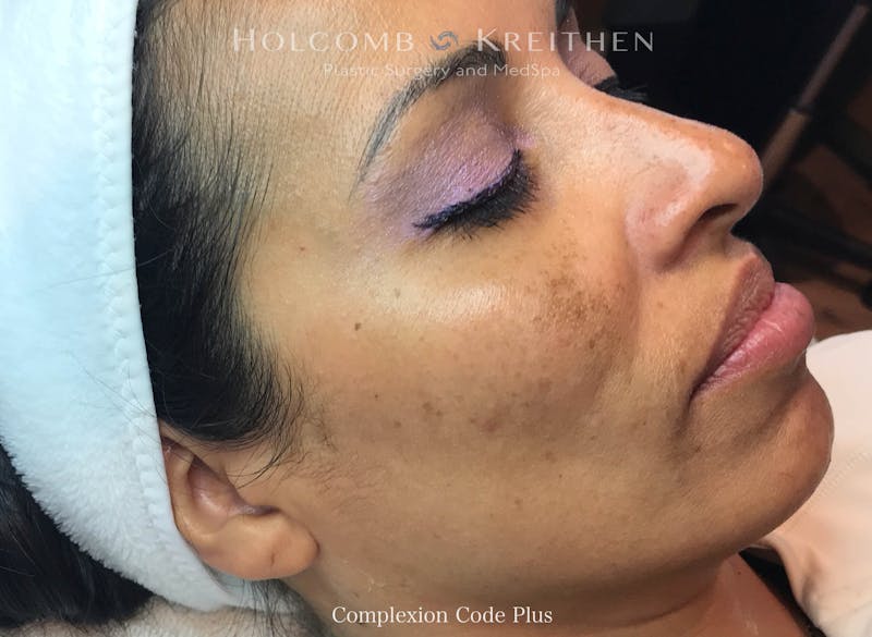 Complexion Code Plus Before & After Gallery - Patient 141952 - Image 1